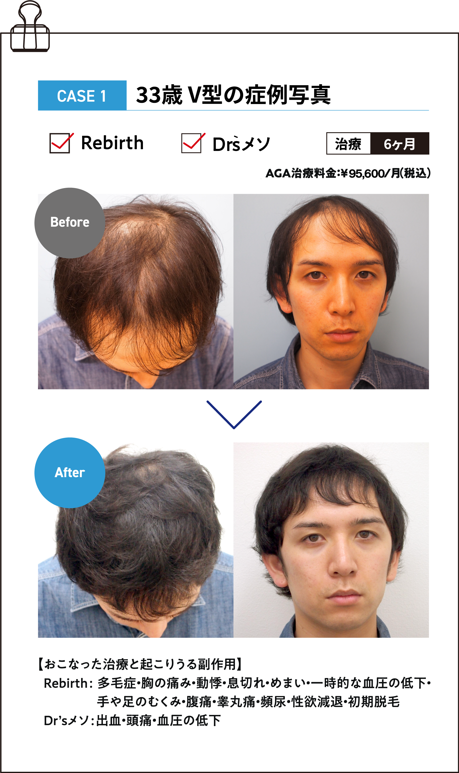 33歳 V型の症例写真