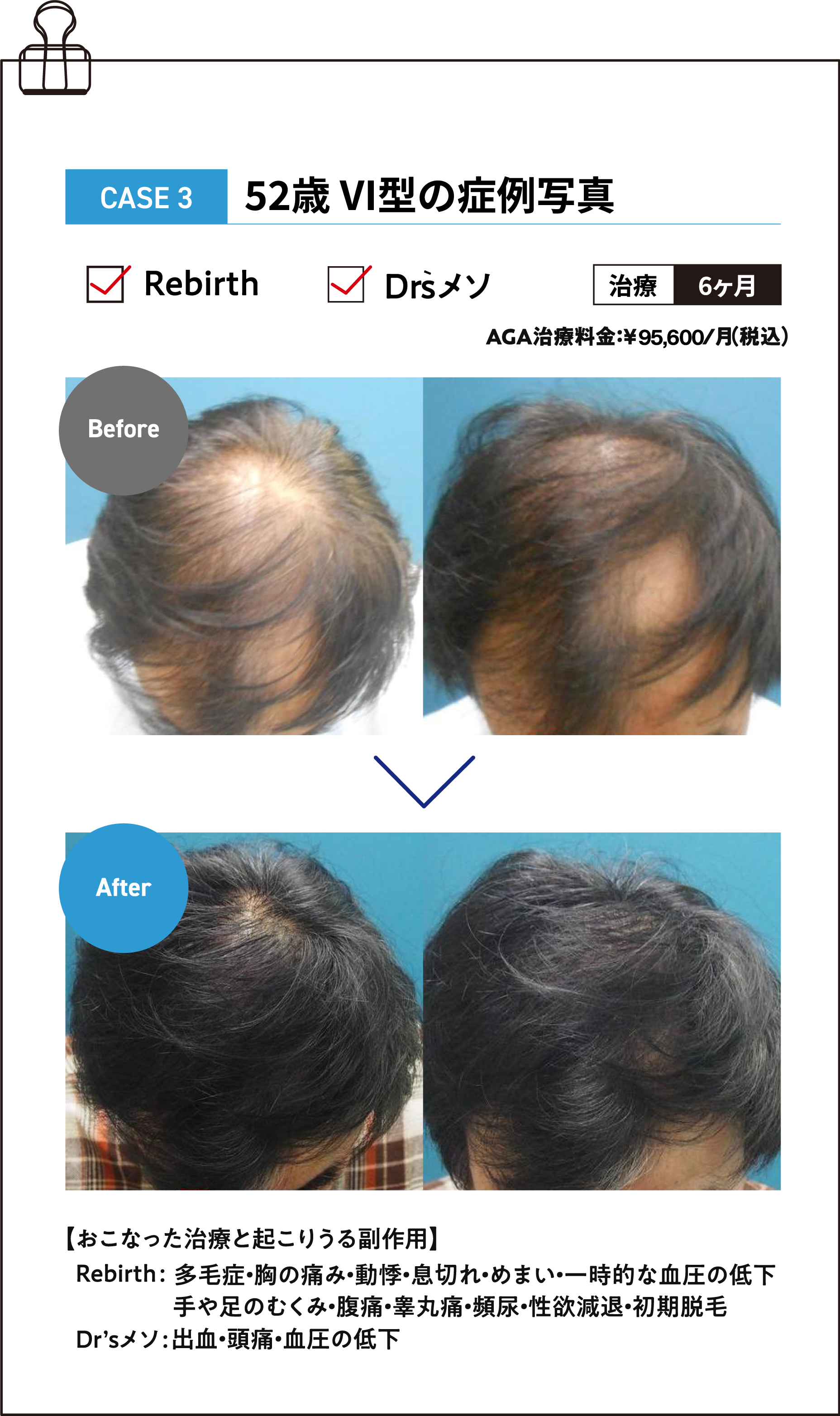 52歳 V型の症例写真