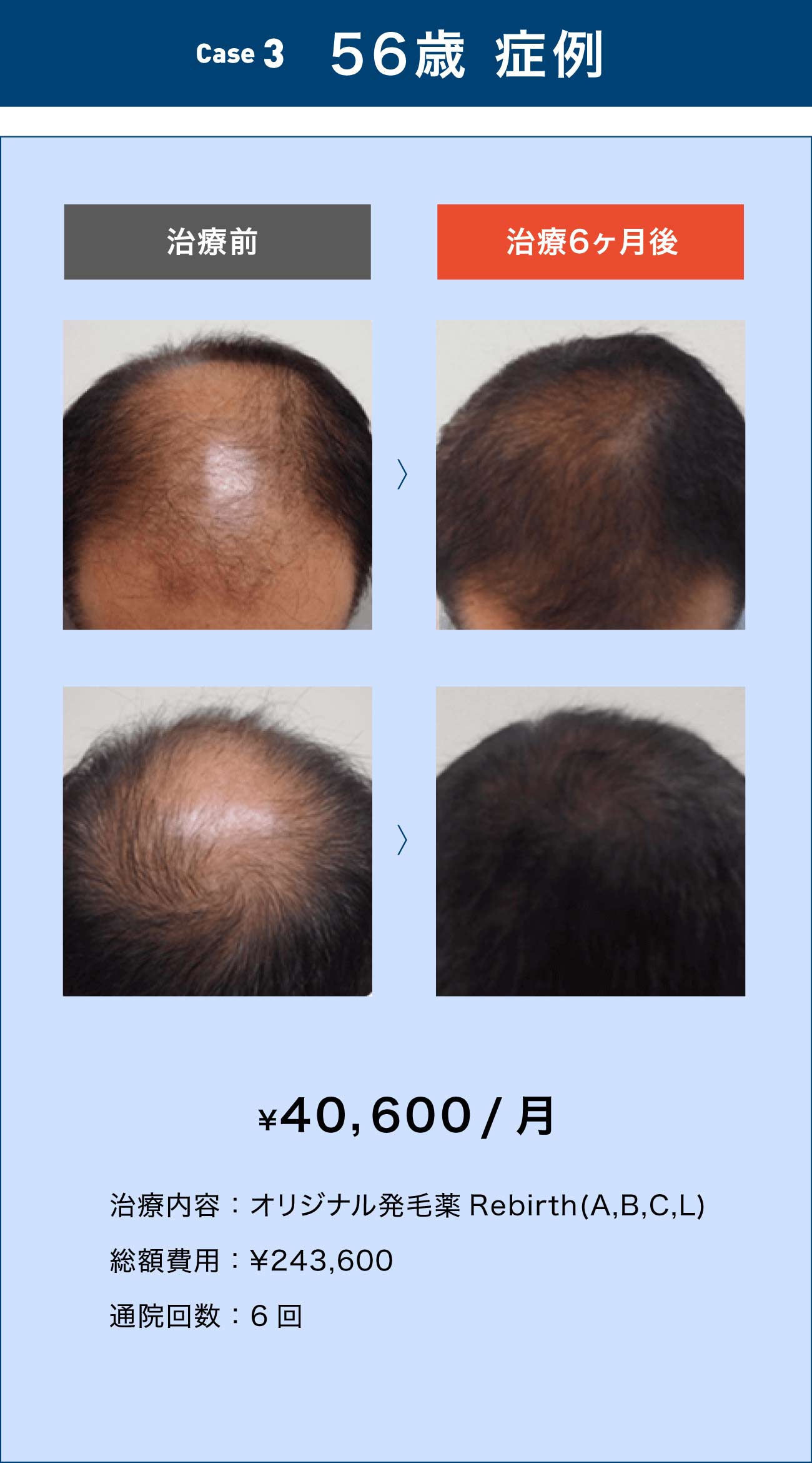 56歳 症例