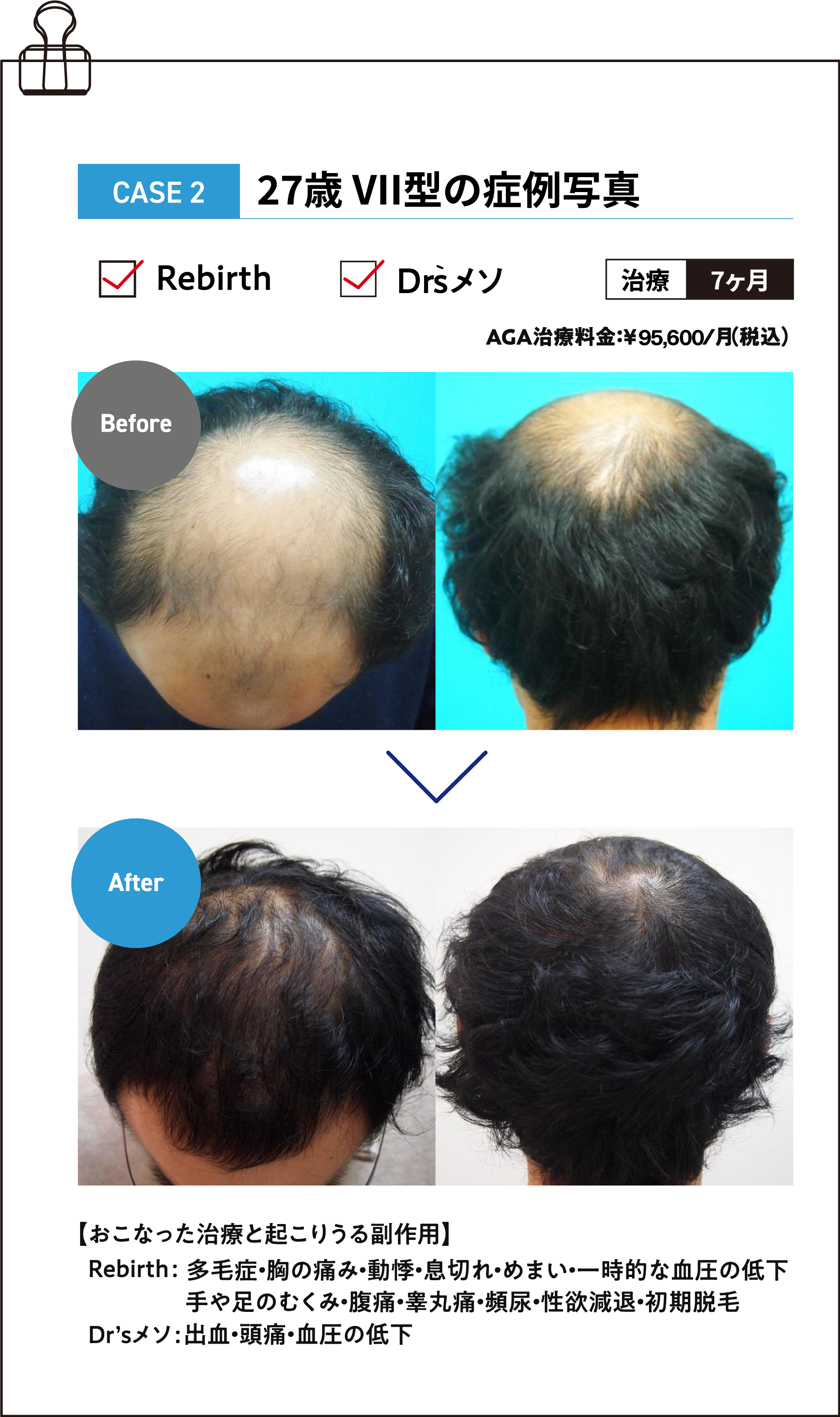 27歳 V型の症例写真